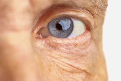 DIABETIC RETINOPATHY